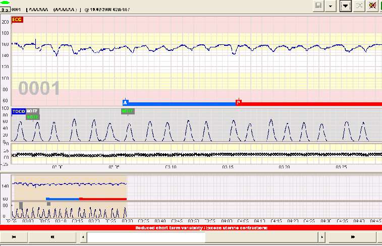 SisPorto Alert, Low Short Term Variability SisPorto Alert, Low Short Term Variability